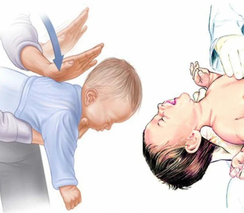 Demonstration of administering back blows for silent choking in infants.