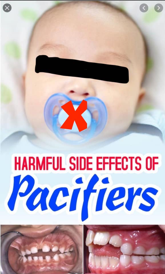 Can pacifiers cause speech delay, baby with pacifier. Dental issues from prolonged pacifier use.